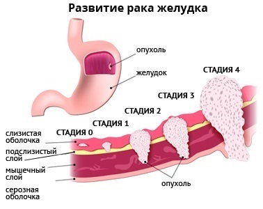 Diéta gyomorrák eltávolítása előtt és után