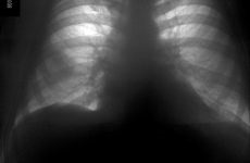 Diagnosticul diferențial al pneumoconiozelor