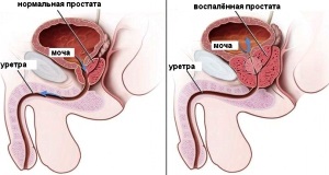 Hatékony krónikus prostatitis