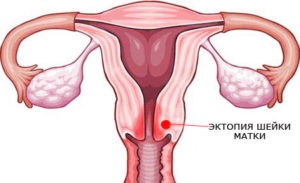 Ectopia colului uterin și tratamentul acestuia