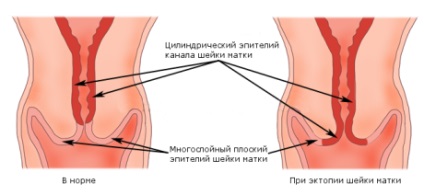 Ectopia cervicală - simptome și metode de tratament