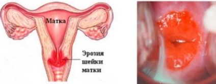 Ectopia cervicală - simptome și metode de tratament