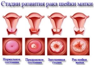 Ectopia cervicală - simptome și metode de tratament