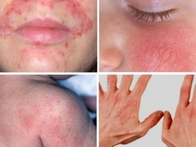 Eczema de la soare de ce apare pe piele, cum să se vindece și cine este expus riscului de îmbolnăvire