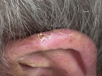 Eczema urechii - principalele cauze, simptome și tratamente - să fie sănătoase