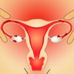 Endometrioza 1 diagnostic grad de tratament al sarcinii