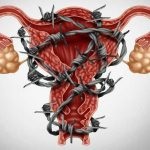 Endometrioza 1 diagnostic grad de tratament al sarcinii