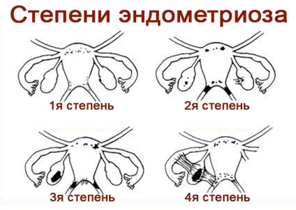 Ендометріоз 1 ступеня лікування діагностика вагітність