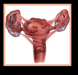 Endometrioza simptomelor uterine și tratamentul