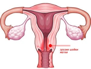 Eroziunea cervicală afectează natura durerii, cauzele acesteia și simptomele însoțitoare, metodele de diagnosticare și