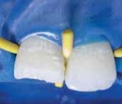 Az elülső fogak esztétikai helyreállítása - terápia - fogászati ​​hírek és cikkek -