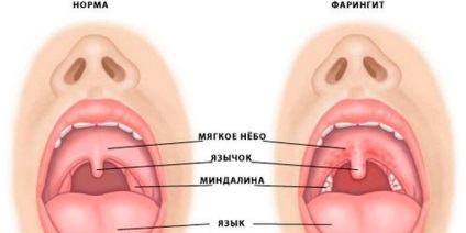 Faringita este ceea ce este și care sunt soiurile