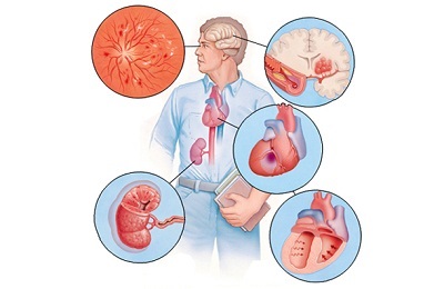 Stadiul bolii și clasificarea hipertensivă