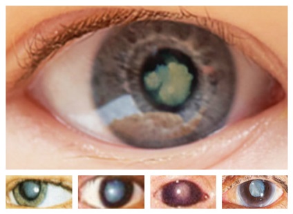 Bolile oculare la tipurile de copii, simptome, cauze, tratament