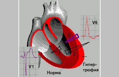 Hypertrophia a szív okozza a veszélyt, kezelés