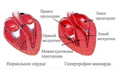 Glj de inima a motivului, în ce pericol, tratament