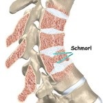 Hernia herniată în simptomele și tratamentul lombar al coloanei vertebrale