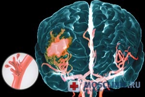 Accident vascular cerebral cauze, simptome, tratament