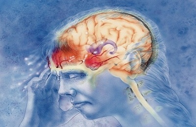 Accident vascular cerebral ischemic din partea dreaptă a efectelor creierului și câți trăiesc