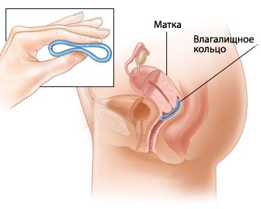 Ce contraceptive sunt cele mai fiabile