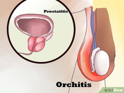 Cum puteți determina dacă aveți epididimită