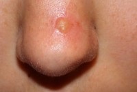 Cum de a bate acnee pe nas în moduri dovedit de ani de zile
