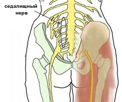 Cum să prindeți corect nervul sciatic