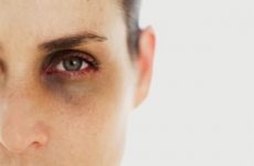 Cum să eliminați cercurile negre sub ochii cauzei