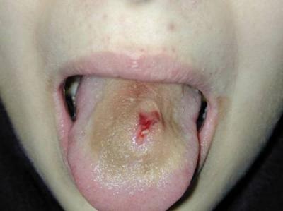 Crezi că piercing-ul limbii fără anestezie este dureros și neplăcut?