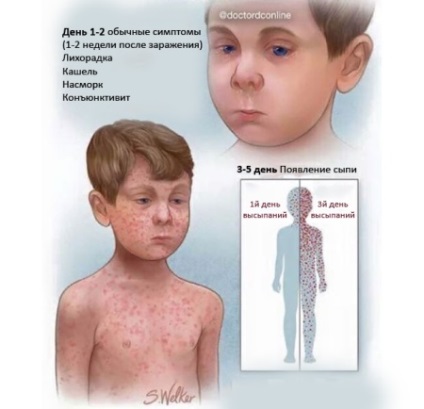 Ce este rujeola la copii (18 poze) semne si simptome in stadiile incipiente cu explicații, erupții cutanate