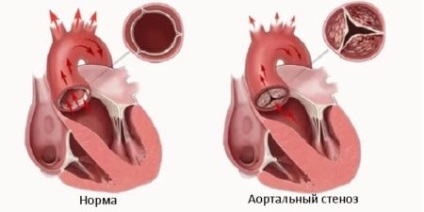 Calcifierea inimii