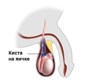 Chistul testiculelor stângi și drepte și capul apendicelui la bărbați se dizolvă singuri