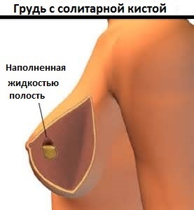 Tratamentul chistului mamar al bolii prin diferite metode