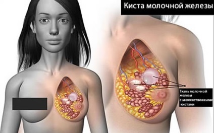 Tratamentul chistului mamar al bolii prin diferite metode