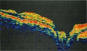 Tomografia coerenței optice clinice a nervului optic