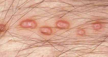 Ciupercă contagioasă pe organele genitale ale fotografiei, aspectul, îndepărtarea, lumea venerologiei