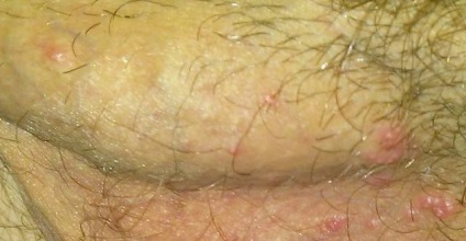 Ciupercă contagioasă pe organele genitale ale fotografiei, aspectul, îndepărtarea, lumea venerologiei