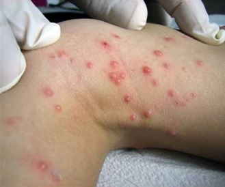 Molluscum contagiosum kezelés a nők