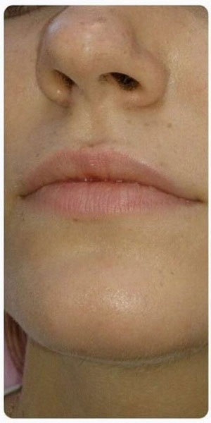 Cremă pentru creșteri ale buzelor despre crema cu buze perfecte de acid hialuronic în farmacie, întinerire