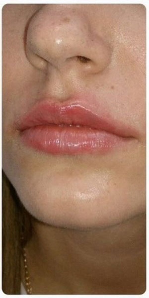 Cremă pentru creșteri ale buzelor despre crema cu buze perfecte de acid hialuronic în farmacie, întinerire