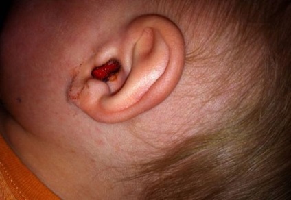 Sânge din ureche cu cauze și tratament al otitei