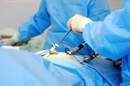 A laparoszkópia (eltávolítás) az összenövések a medence Moszkvában megfizethető áron, tapasztalt orvosok