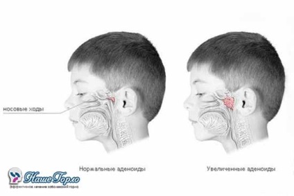 Tratamentul medicamentelor cu adenoide, proceduri