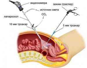 Tratamentul după laparoscopia ovariană - ginecologie - catalog de articole - sănătate și ginecologie feminină