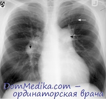 Vasculita pulmonară