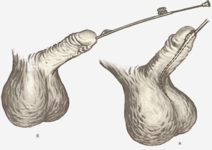 Meatotomie (disecția deschiderii externe a uretrei cu laser)