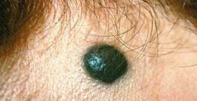 Melanomul Nodurile simptome, cauze, metode de tratament, metode de diagnostic,