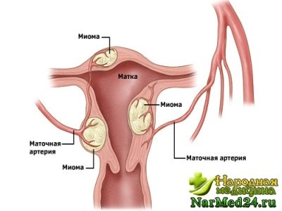 Iomul uterului cauzează apariția acestuia, simptomele și metodele de tratament cu remedii folclorice