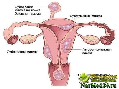 Iomul uterului cauzează apariția acestuia, simptomele și metodele de tratament cu remedii folclorice