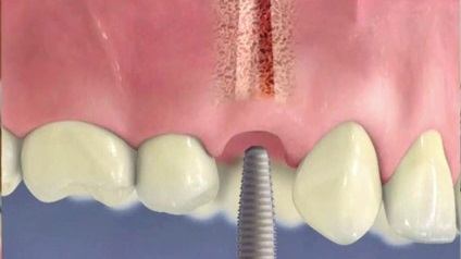 Fie că este posibil să faci sau să faci mrt cu implanturi ale dinților și ce restricții